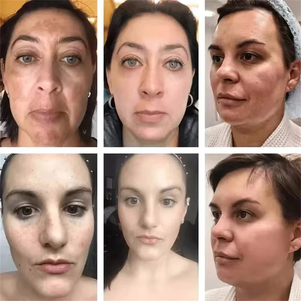 Dark Spots Remover Whitening Serum Face Freckle Melanin Correcting Reduce Fine Lines Brighten Essence Korean Beauty Skin Care