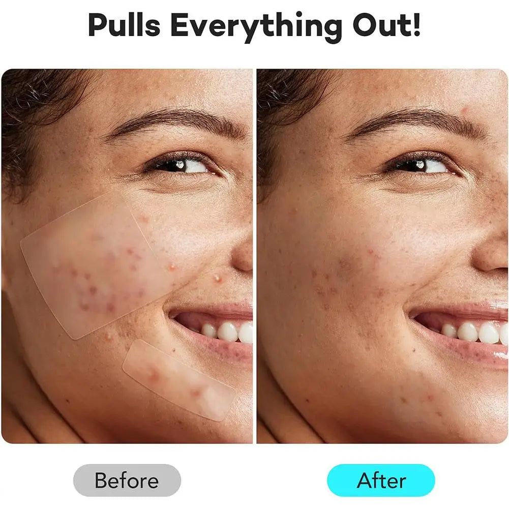 2 Sizes Invisible Professional Healing Absorbing Spot Sticker Covering for Men Women 1set Face Skin Care Acne Pimple Patch